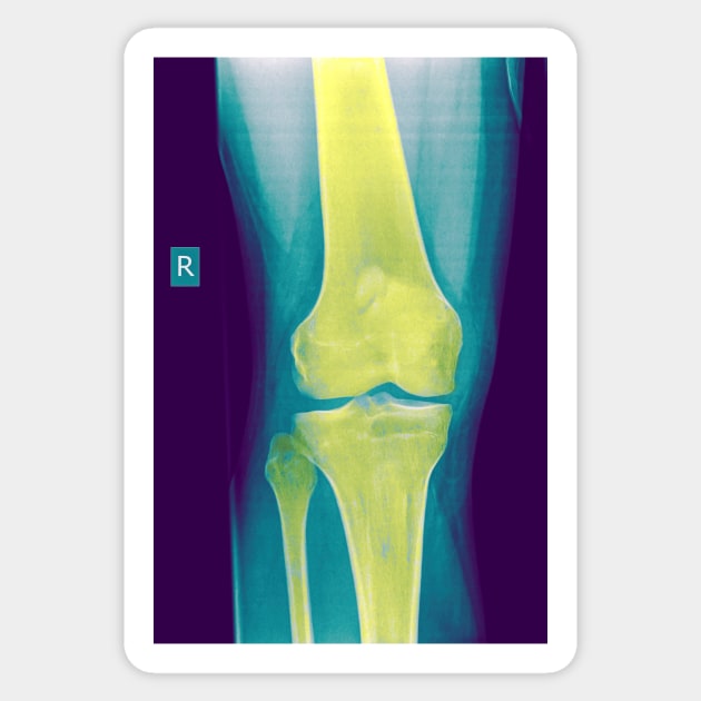 Knee x-ray (C022/3104) Sticker by SciencePhoto